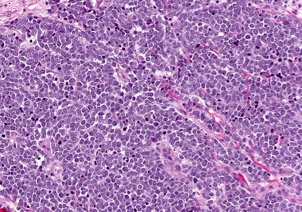 MCC pathology 