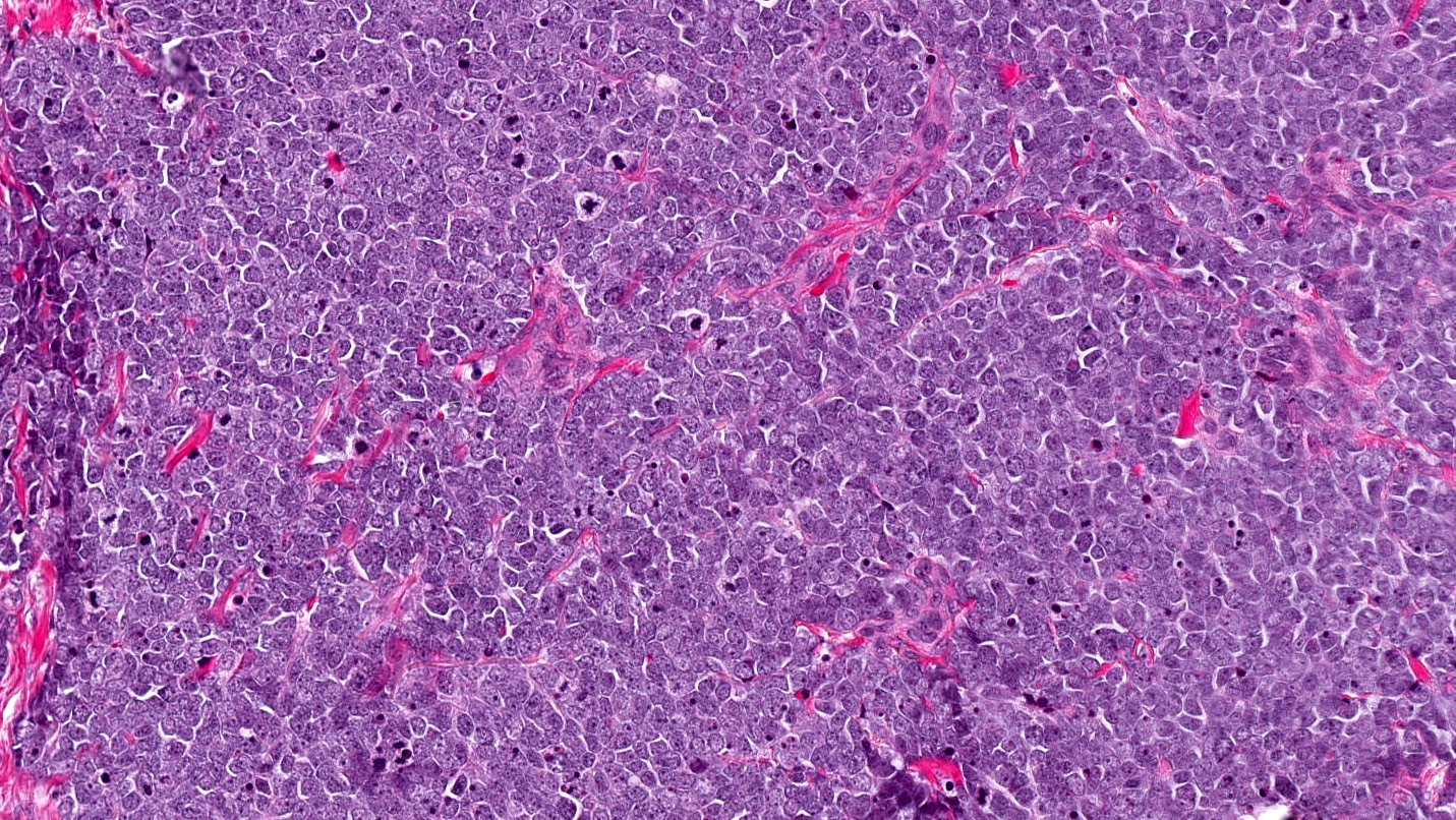 MCC pathology 